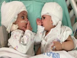 Yapışık doğan ikizler 12 saatlik ameliyatla ayrıldı
